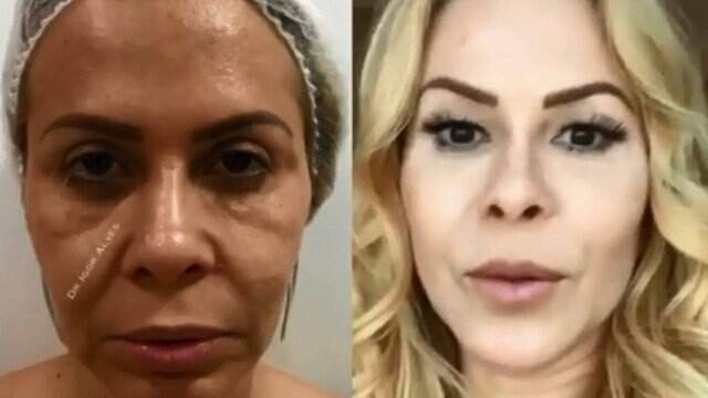 Joelma antes e após o procedimento 