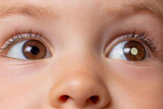 O retinoblastoma é hereditário e representa cerca de 3% dos cânceres infantis do Brasil, chegando a uma média de 400 casos por ano 