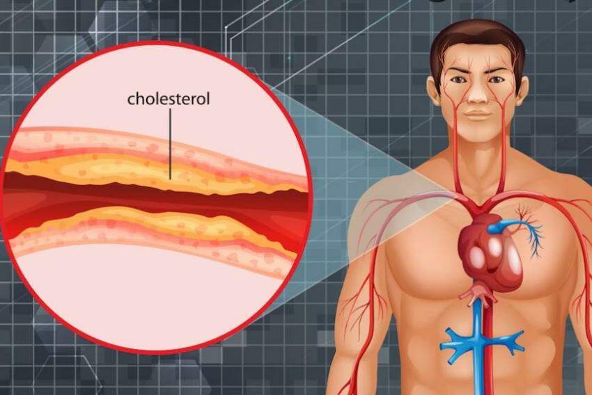 O LDL é conhecido como 'colesterol ruim'; em excesso pode se depositar nas artérias, levando à formação de placas de ateroma e obstrução do fluxo sanguíneo