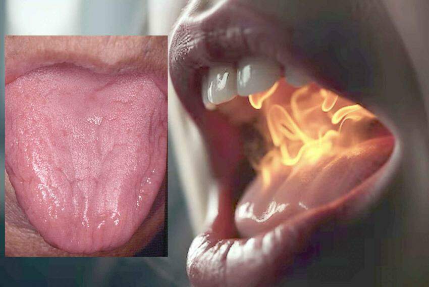 Na Glossodinia a língua tem sintoma de queimação, mas os aspectos são de normalidade estrutural, sem manchas, despapilamentos e qualquer outro sinal.