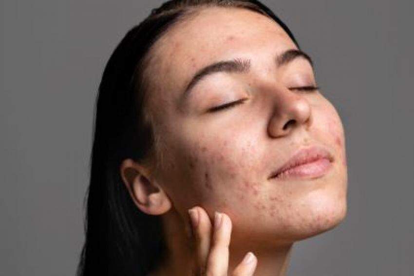 Acne é uma condição da pele que extrapola a adolescência