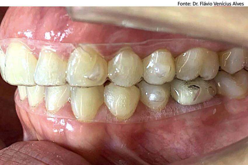Alinhador dentário posicionado para atuar sem o uso de fios e braquetes típicos dos aparelhos ortodônticos convencionais