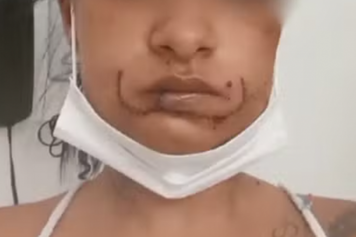 A mulher que precisou fazer uma cirurgia para reconstruir o lábio