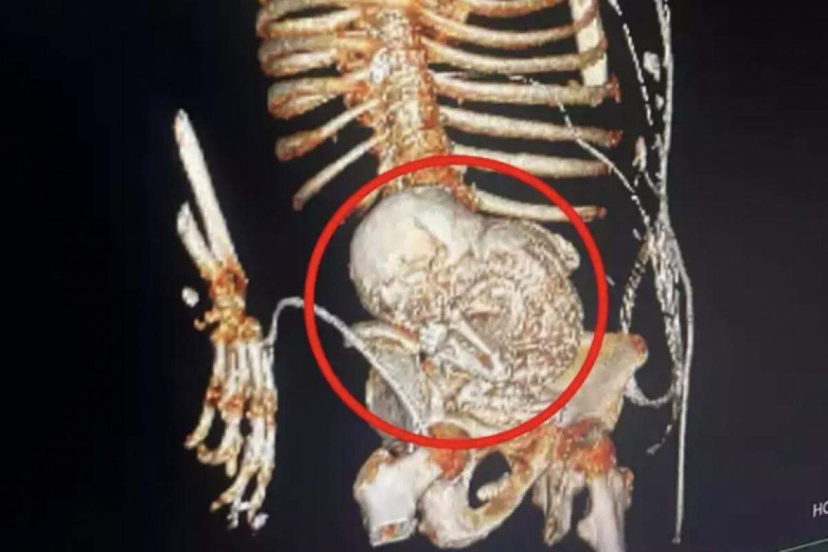 Tomografia revelou feto mumificado