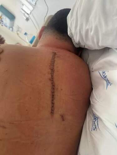 Cicatriz da cirurgia na coluna