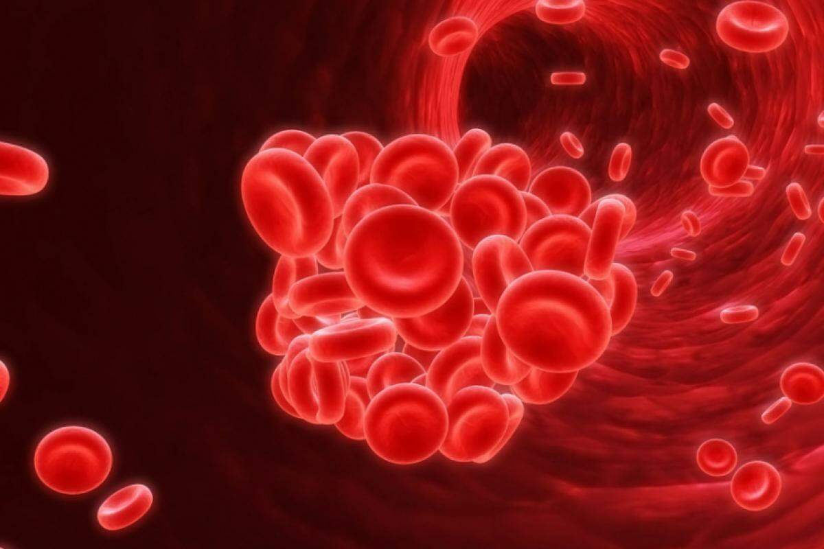 A hemofilia é uma doença genética caracterizada pela falta de proteínas necessárias para a coagulação do sangue