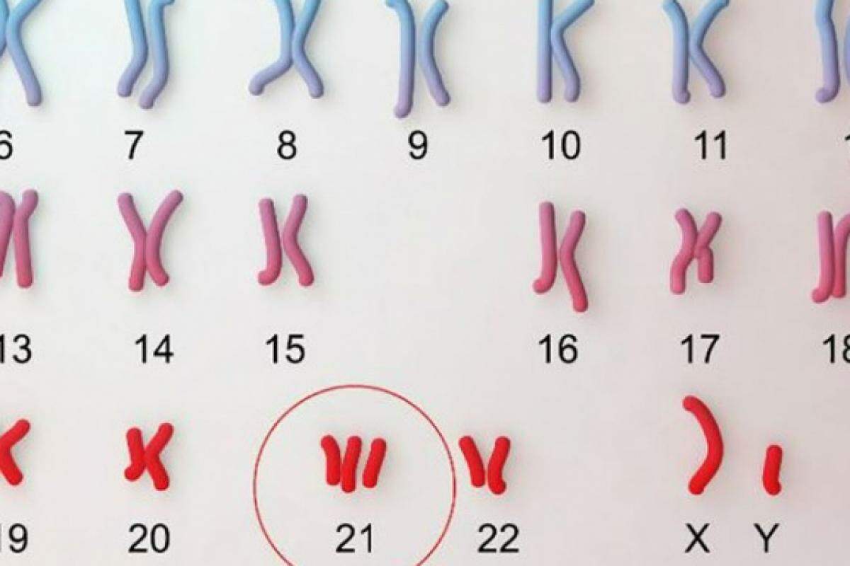 A trissomia do cromossomo 21 (T21) é uma doença genética