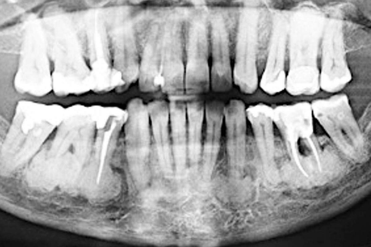 Na mandíbula, o osso tem aspecto de chumaços de algodão ao redor das raízes dentárias na Displasia Cemento-Óssea Florida.