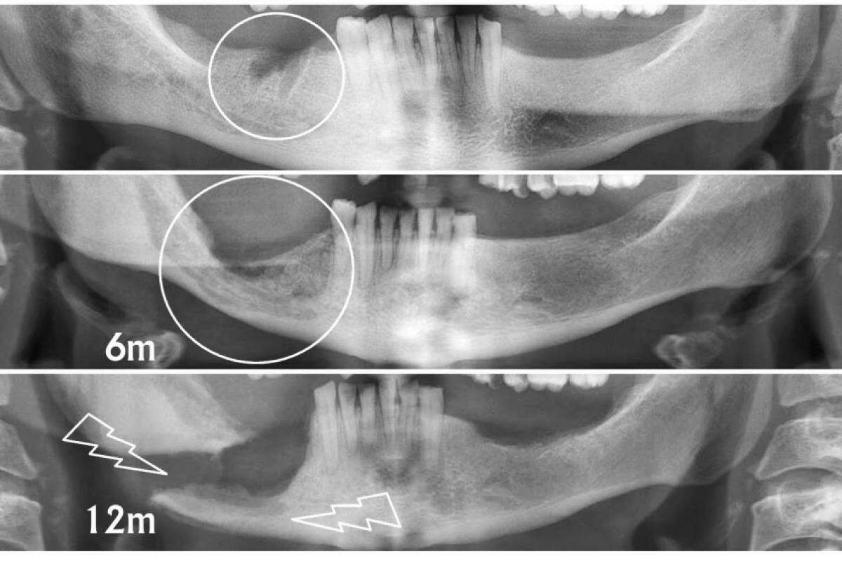 Paciente pediu ao profissional para extrair o dente que o incomodava. Local foi porta de entrada bacteriana (em 6m houve osteomielite e 12m fratura secundárira)