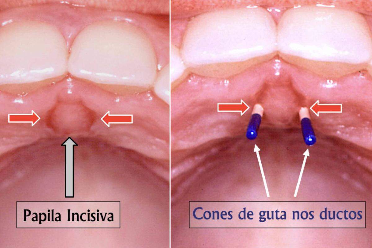 Comunicação da boca e nariz pelos ductos nasopalatinos indicados pelas setas vermelhas