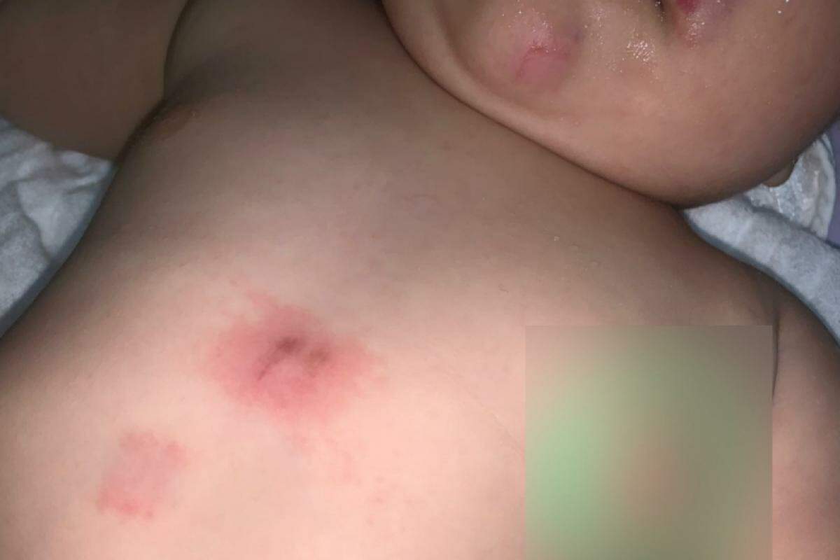 Pais registram queixa após bebê de 9 meses retornar da creche com ferimentos no rosto, peito e mãos; imagens de segurança não foram liberadas