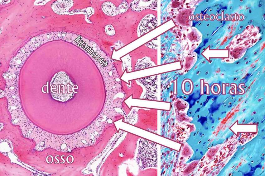  As células que reabsorvem o osso, os osteoclastos, demoram 10 horas para chegar até o ligamento periodontal para começar a movimentar os dentes