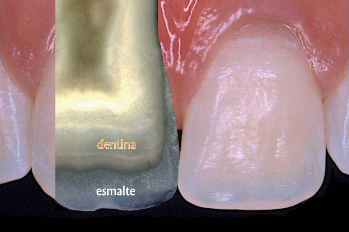 Composição de imagens para destacar a relação esmalte-dentina e a cor dos dentes!