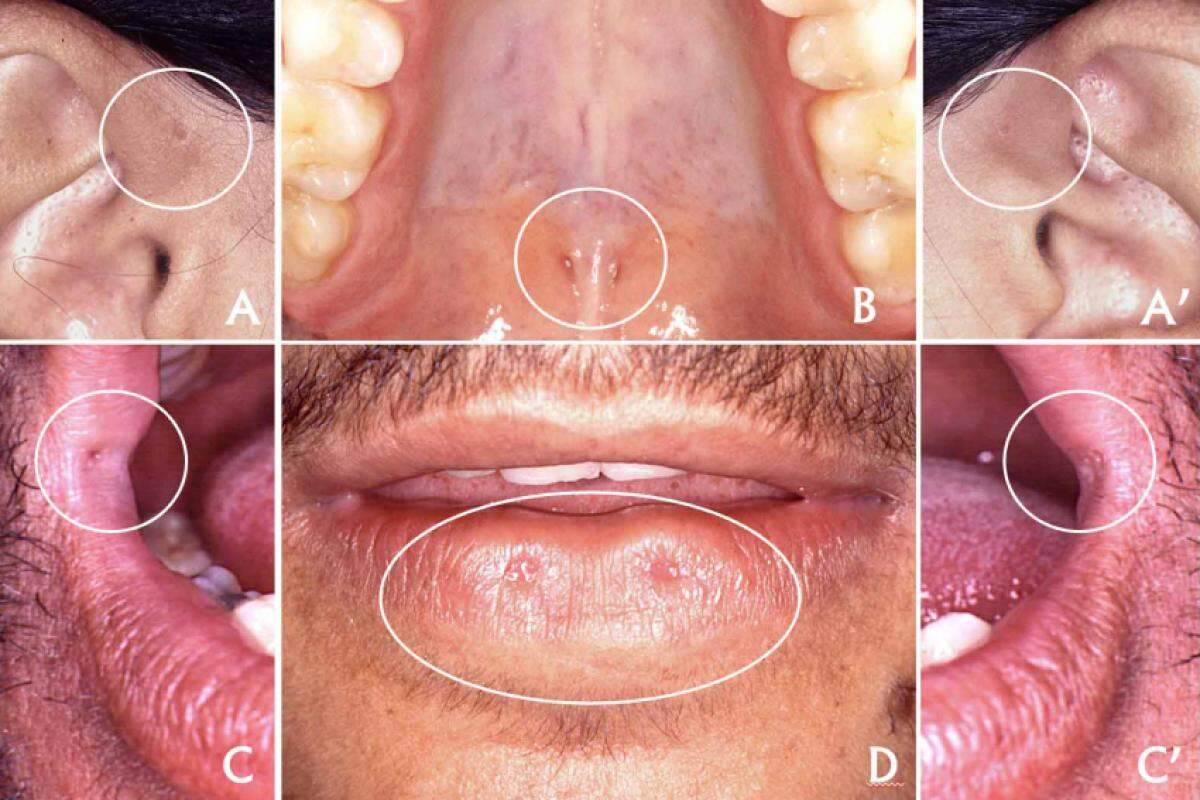 Fossetas pré-auriculares (A e A’), fossetas de Stieda (B), fossetas comissurais (C e C’) e as fossetas congênitas da porção mediana no lábio inferior (D)