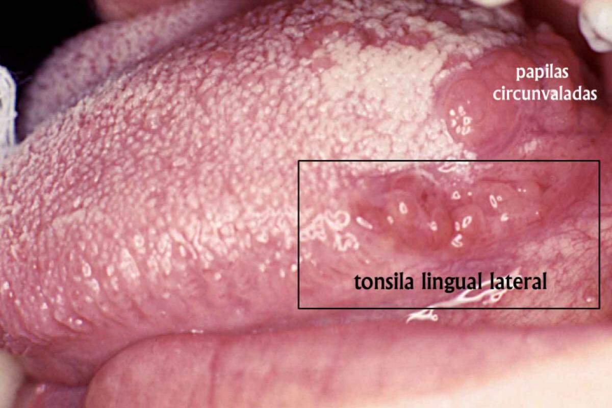 Tonsila lingual lateral ou acessória discretamente aumentada!