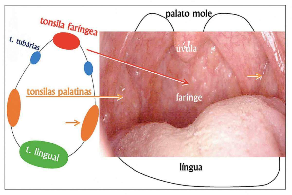 Anel de Waldeyer ao redor da garganta, sendo dois componentes presentes na fotografia:  as tonsilas palatinas e a tonsila faríngea (setas).