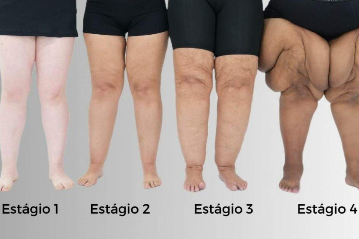 Embora a perda de gordura convencional não elimine diretamente o lipedema, a alimentação pode ter um papel essencial no controle da inflamação