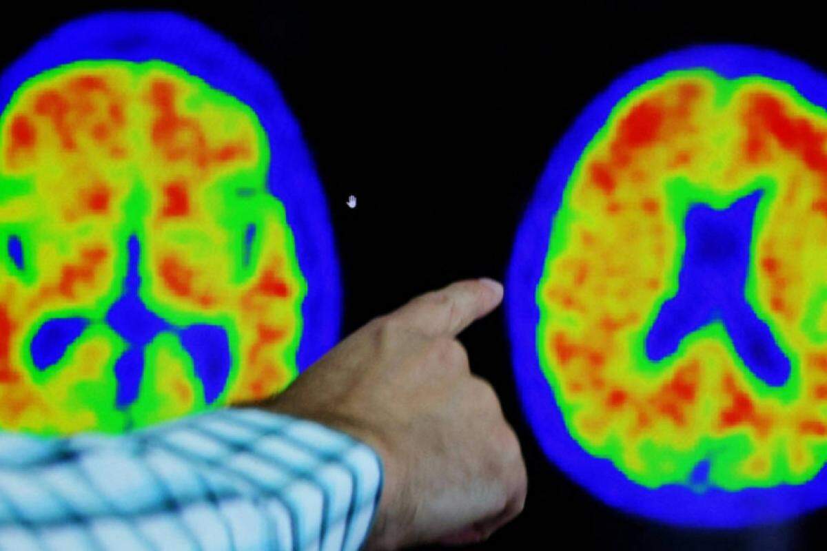 Cientistas identificaram 14 fatores de risco associados à metade dos casos de demência no mundo 