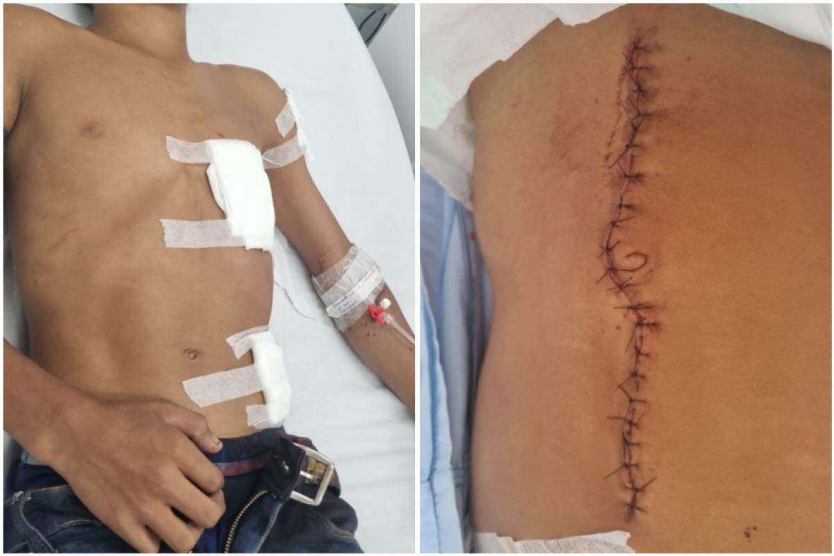 Irmãos após serem esfaqueados em Itirapuã