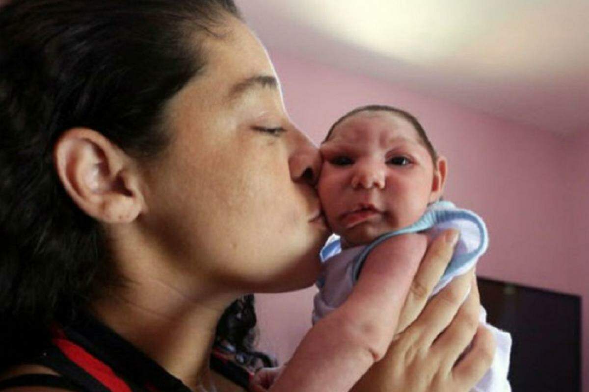 A explosão de casos de microcefalia em crianças associada ao zika vírus aconteceu entre 2015 e 2016, quando foram notificados 12.716 casos suspeitos.