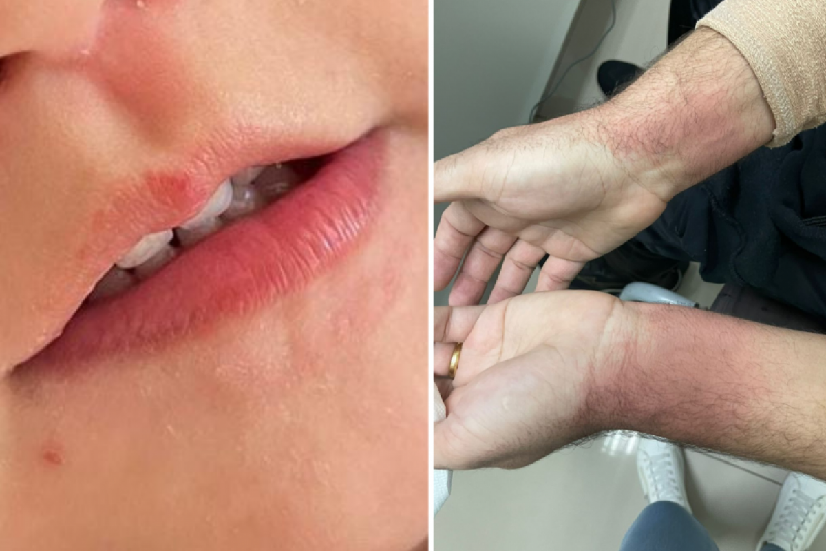 Criança e pai foram atingidos nos olhos e na boca pelo spray de pimenta