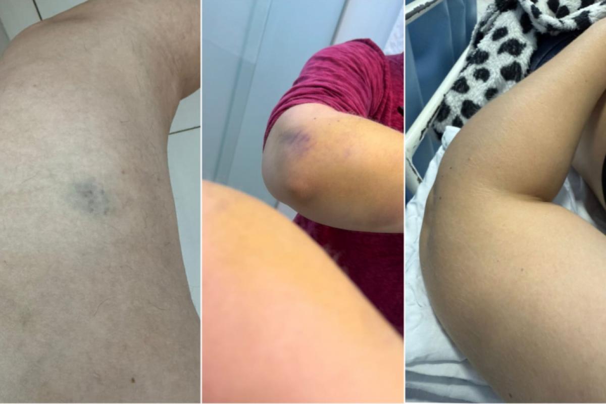 Hematomas no corpo da mulher vítima de agressões
