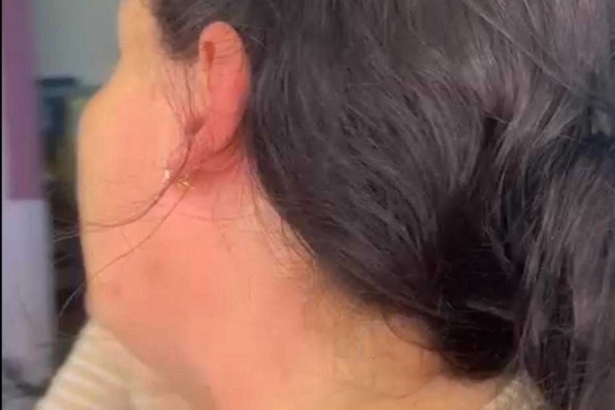 Servidora municipal com marcas após ser agredida em Pedregulho