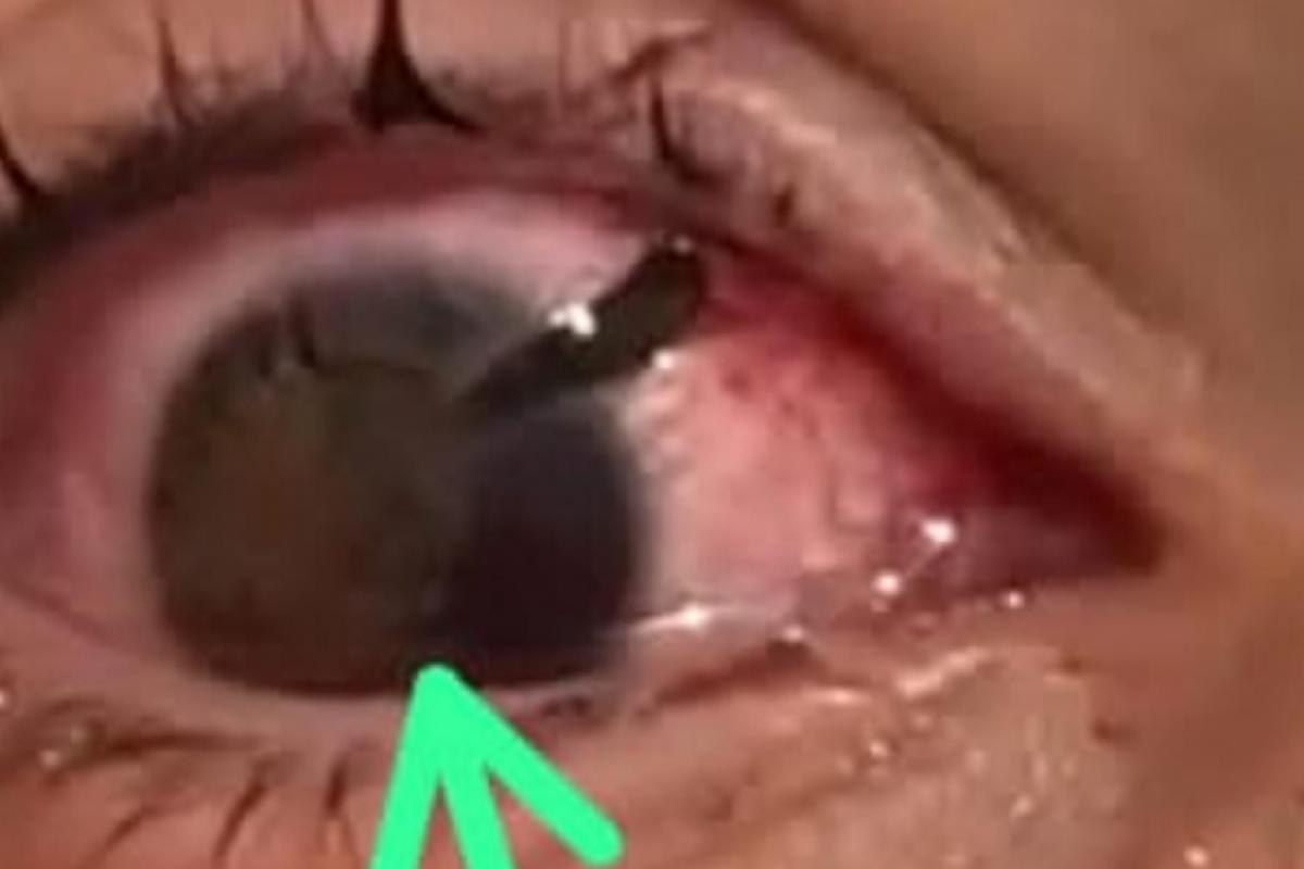 Olho do adolescente de 15 anos ferido por estilhaços de vidro durante brincadeira em sala de aula; ele passou por duas cirurgias e corre risco de perder a visão