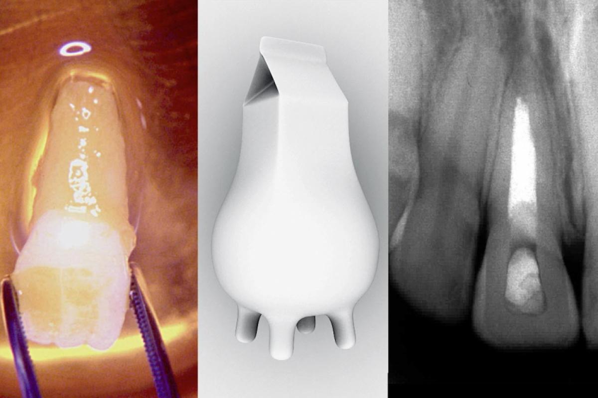 O leite é rico em EGF, o mediador que impede o osso de encostar no dente e  usado no caso após 10 anos, e preservado