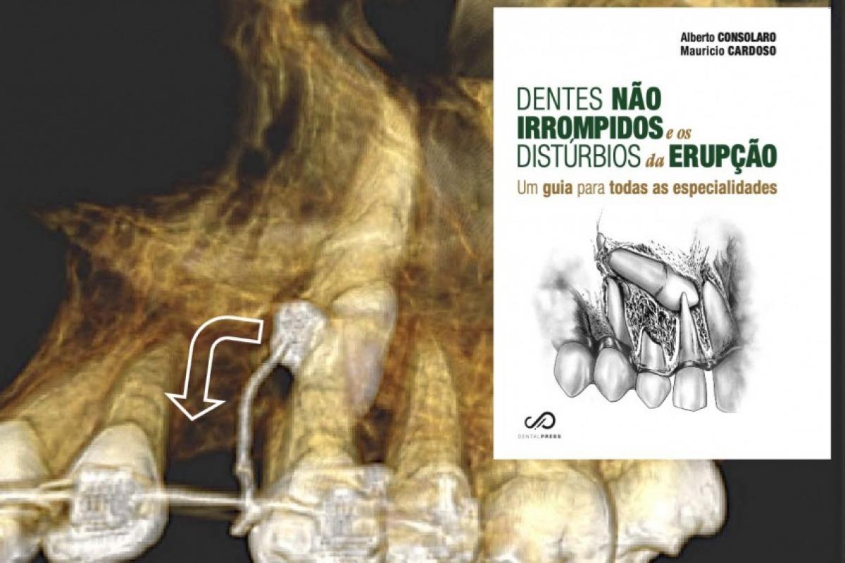 Canino sendo tracionado para o seu lugar no plano oclusal com fios metálicos e a capa do livro de 652pg com 3600 figuras