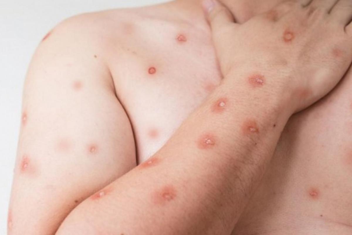 O paciente é um homem, com idade entre 30 e 39 anos, residente em Jundiaí