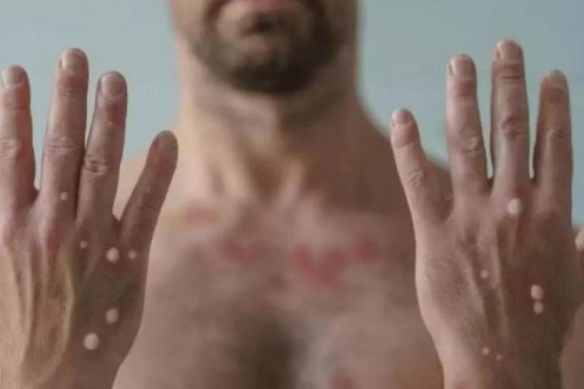 Dos 93 casos de mpox confirmados no Estado de São Paulo, dois foram na RMJ