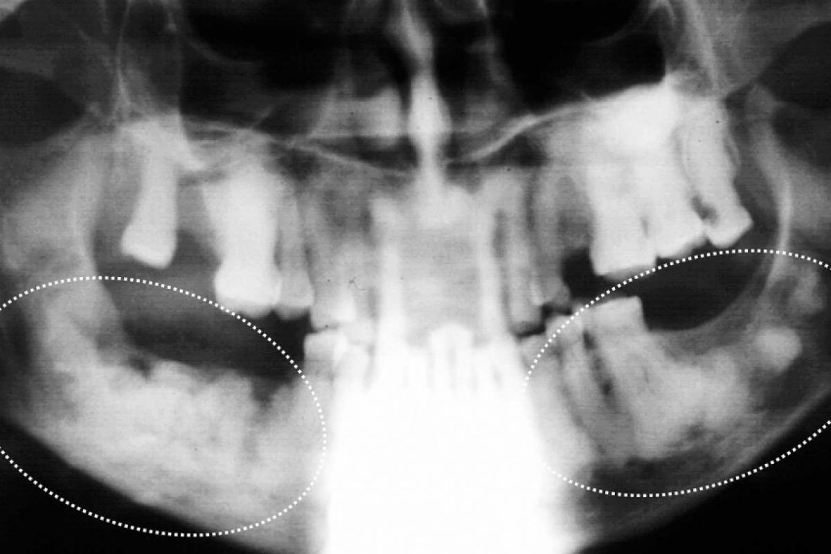 Na mandíbula, forma-se osso denso que se parece com flocos de algodão nas radiografias da Displasia Cemento Óssea Florida