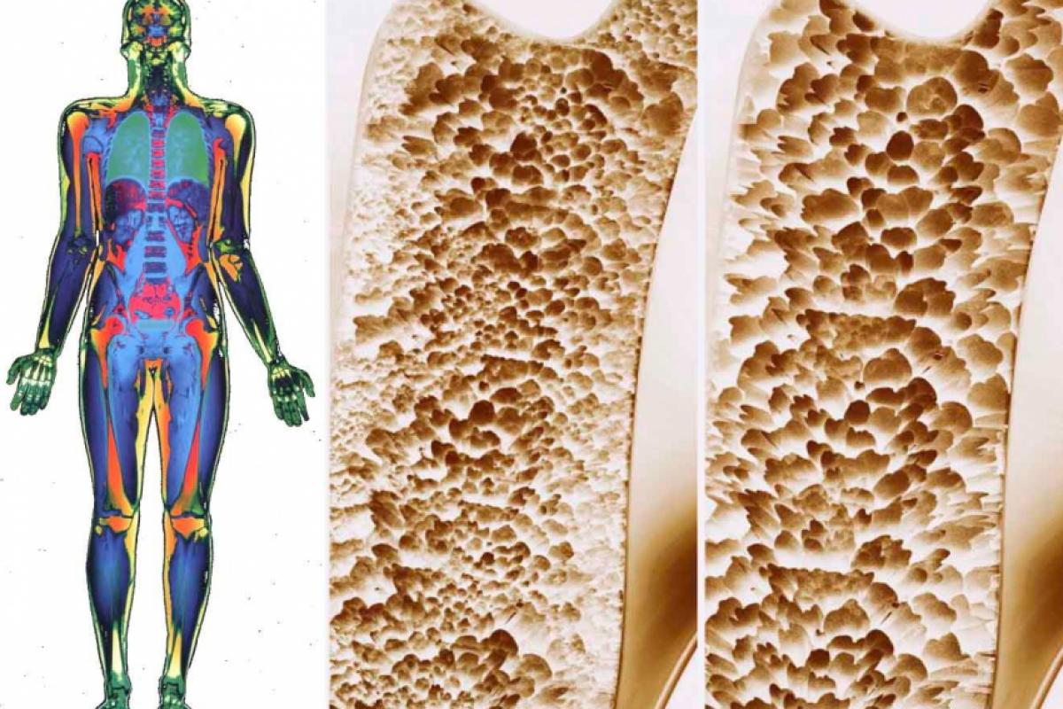 Na osteopenia e osteoporose, a fragilização das estruturas ósseas de origem sistêmica não afeta os maxilares