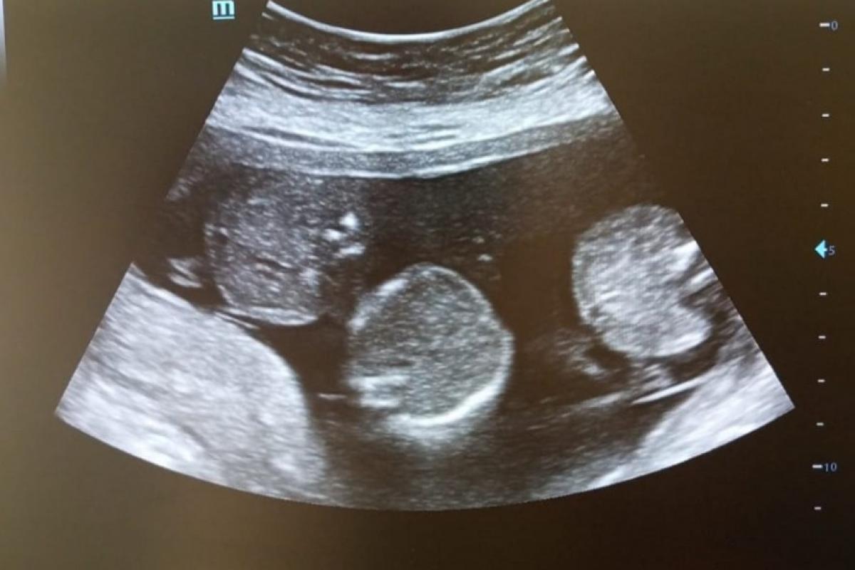 Ultrassom dos trigêmeos que foi realizado em Dezembro