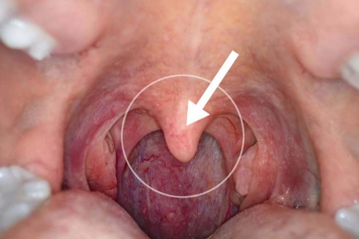 A forma clássica de uma úvula normal na internet.