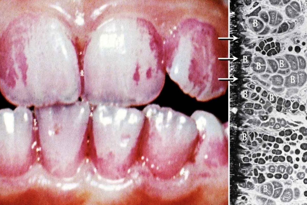 O biofilme, em vermelho, tem várias camadas de bactérias (B) que agregam outros microrganismos na superfície dentária (setas) ao microscópio eletrônico