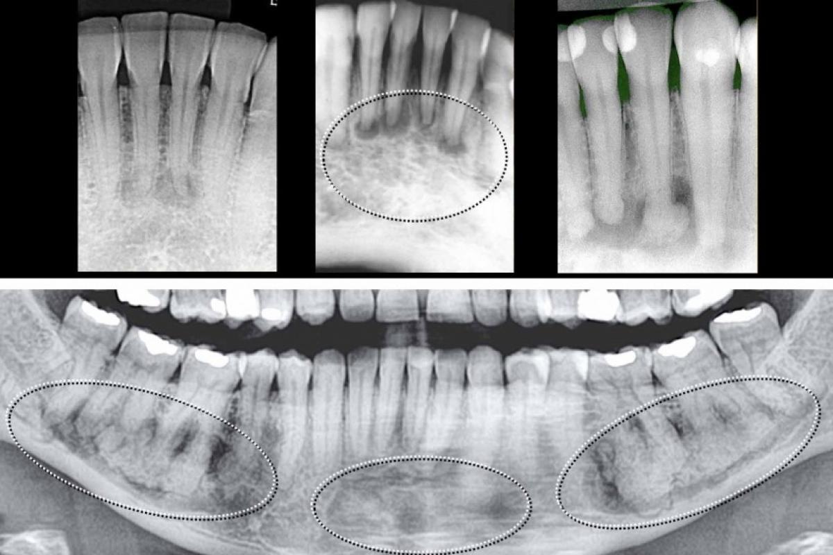 Imagens da Displasia Cemento-óssea Periapical na parte de cima, e da Displasia Cemento Óssea Florida em baixo