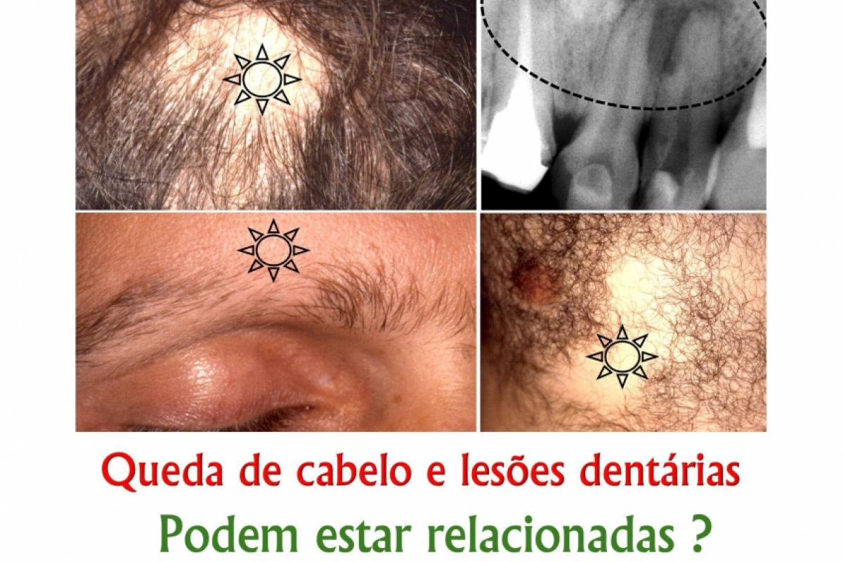 Alopecia areata no couro cabeludo, sobrancelhas e pele do tórax, com lesões periapicais nos dentes