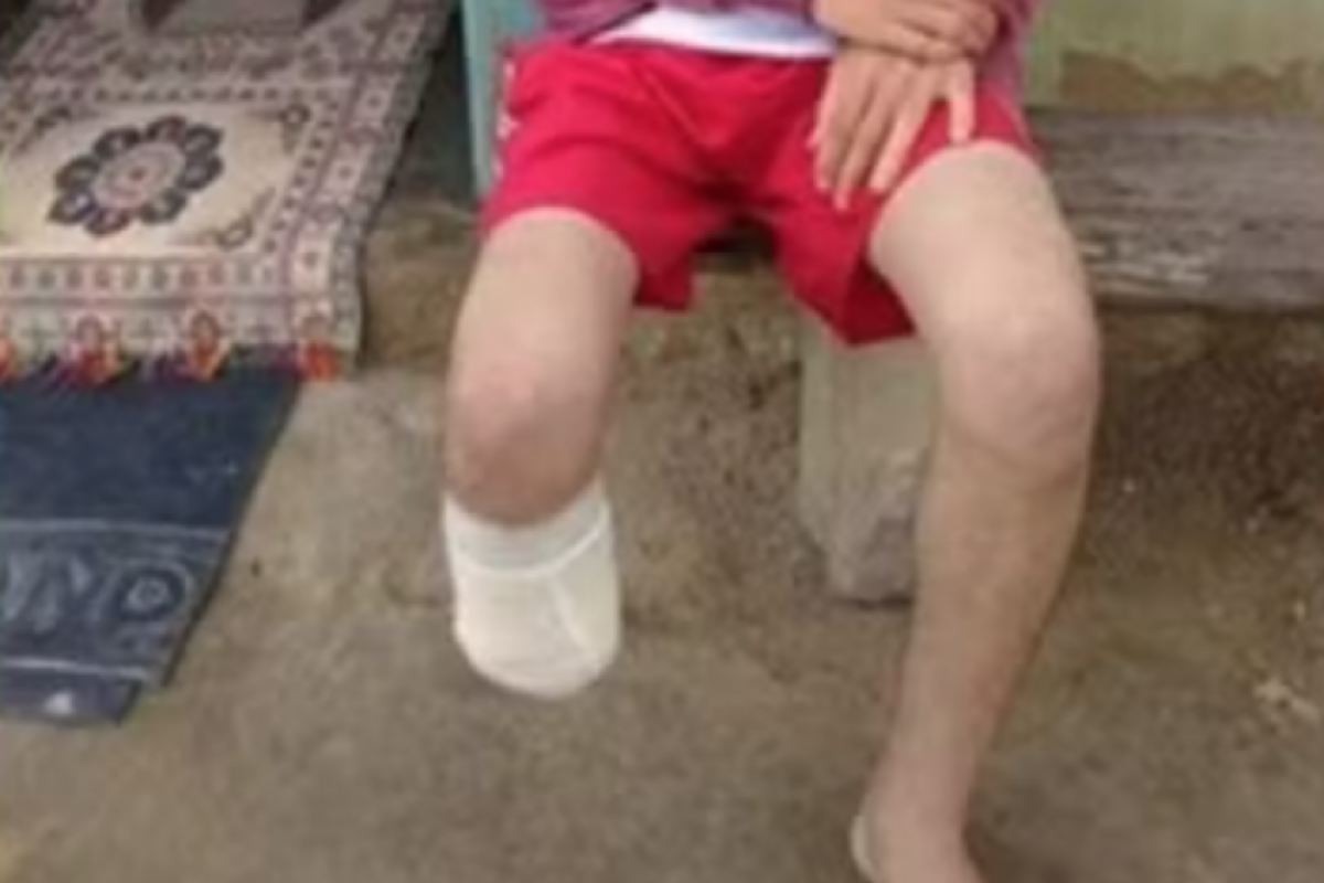 Homem alegou à polícia ter sido vítima de um assalto seguido de sequestro, durante o qual criminosos teriam amputado o pé dele com facão.