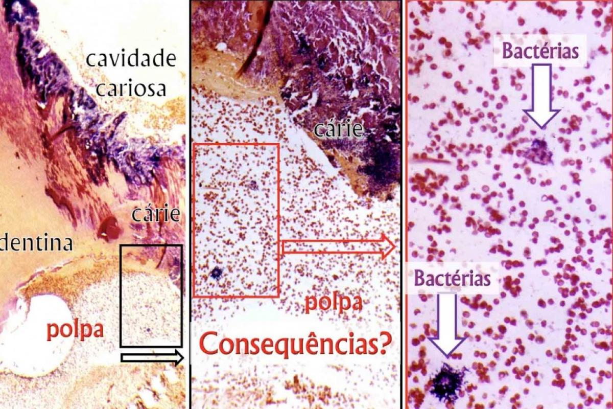 Em um dente decíduo com cárie, as bactérias e pequenos aglomerados puderam ser observados em polpas ainda vitais.