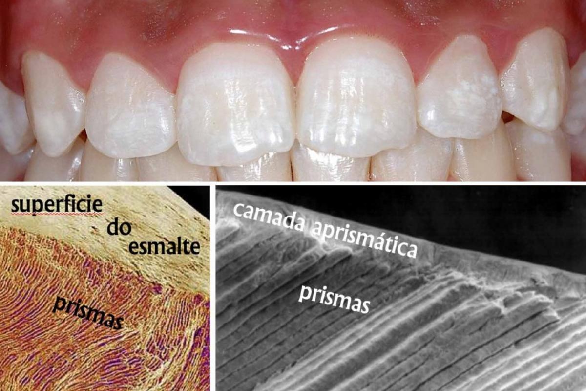 Prismas de esmalte são milhões de colunas unidas de tecido muito duro; na superfície tem as pontas recobertas por uma muito fina camada de cristais
