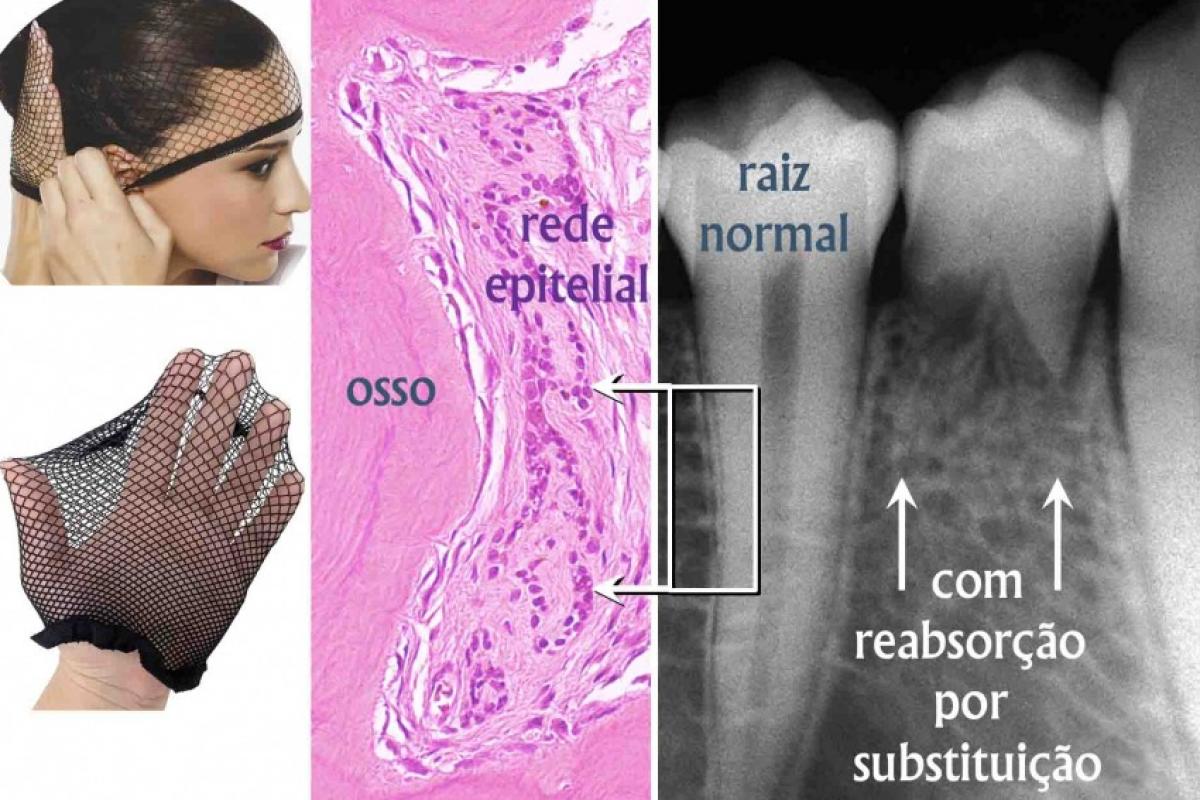 Rede epitelial de Malassez no microscópio e a Reabsorção por Substituição de um dente traumatizado na radiografia 