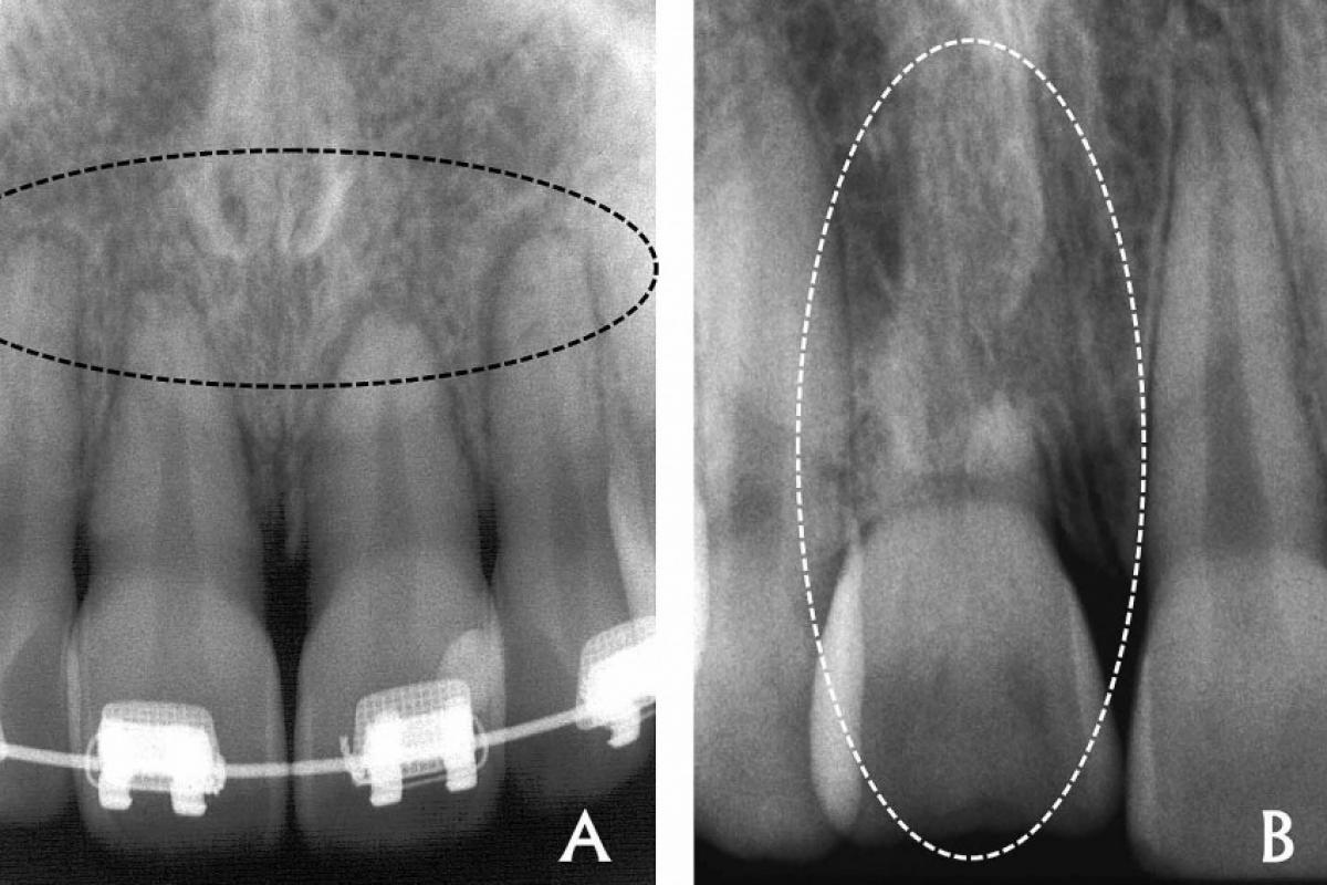 Reabsorção Apical Externa Inflamatória por movimentação ortodôntica (A) e Reabsorção por Substituição por traumatismo dentário (B)