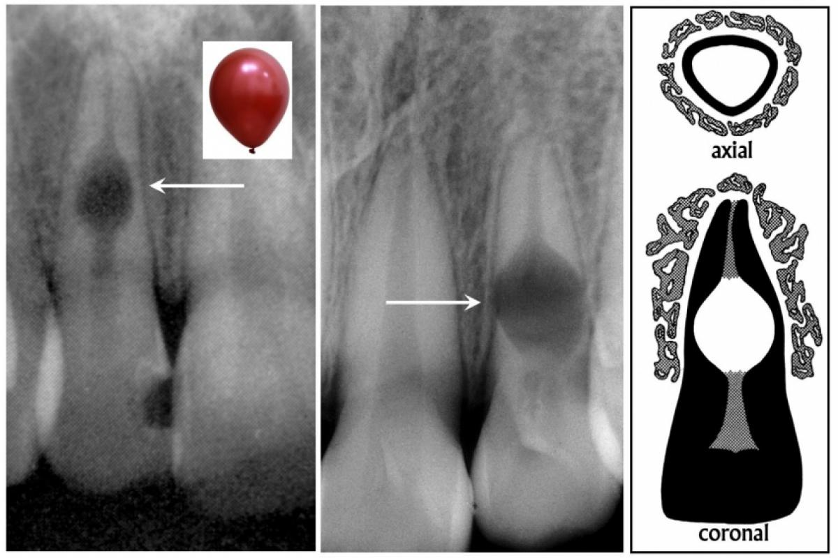 Reabsorções Internas em radiografias periapicais e, no esquema, tem-se cortes esquemáticos axial e coronal 