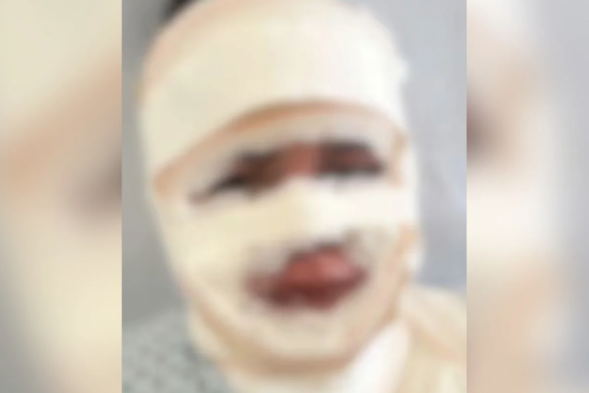A mulher entrou na casa do ex enquanto ele e a jovem dormiam e derramou água quente sobre o rosto da vítima.