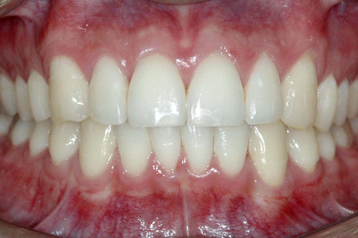 Ninguém pode falar que não teve traumatismo dentário, afinal as concussões passam despercebidas diariamente, pois são muito sutis!