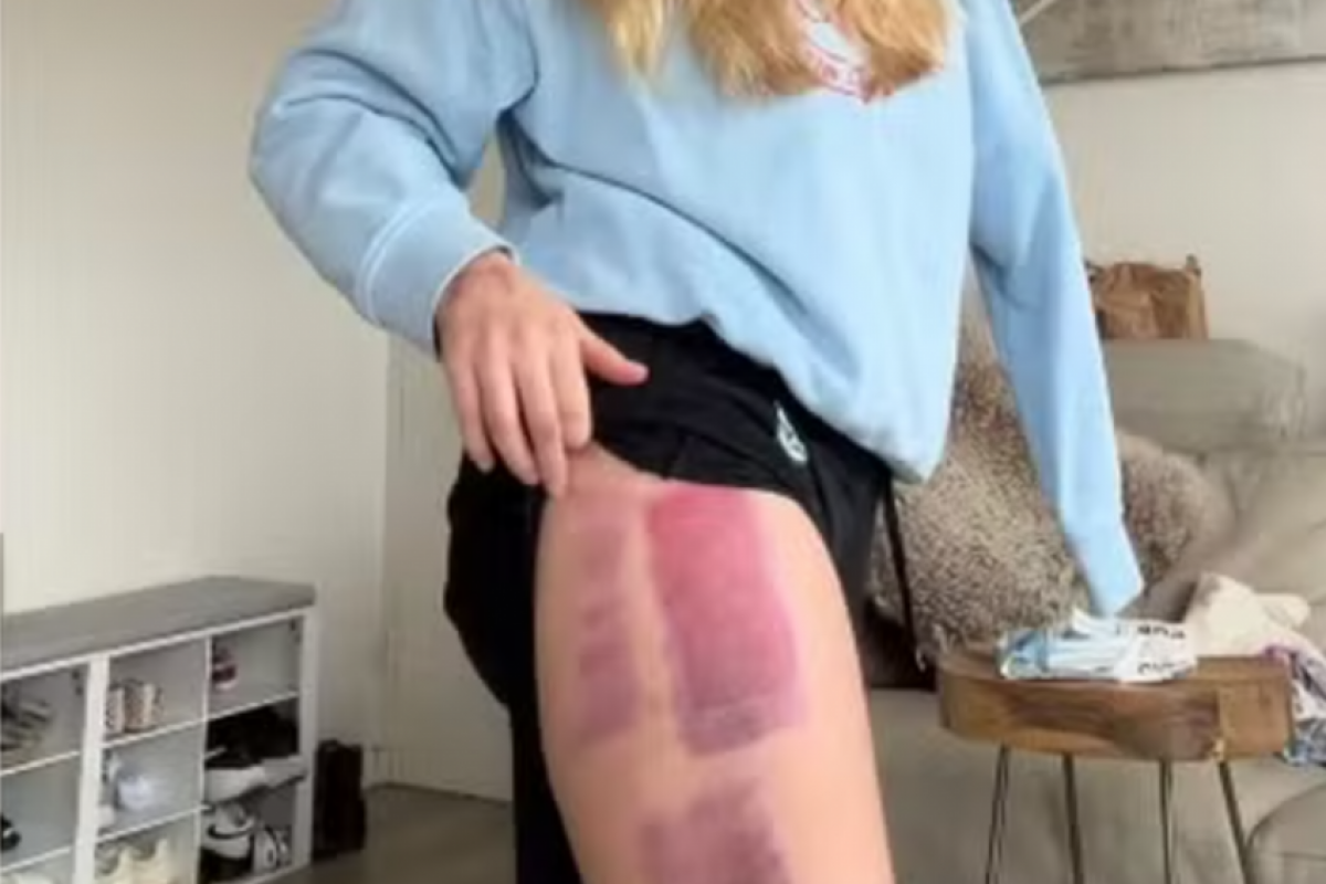 Em vídeo publicado no Instagram, Leah contou que recebeu a confirmação da falha do enxerto após avaliação médica.