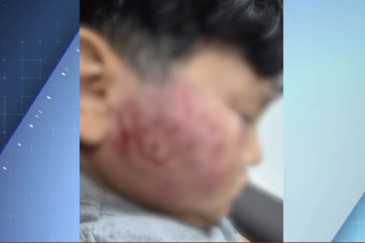 A direção da creche alegou que o menino foi mordido por outra criança na sala do dormitório.